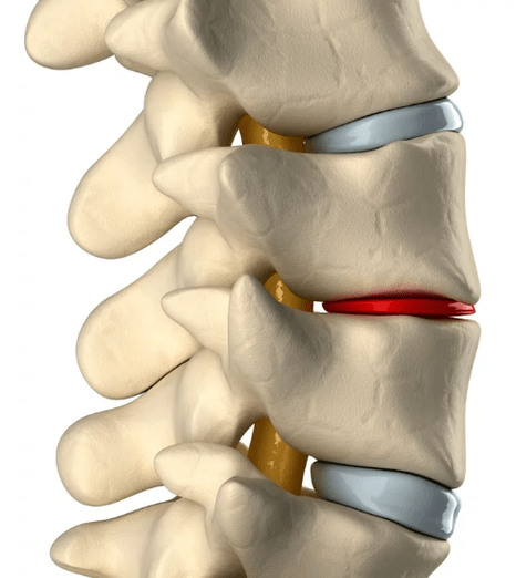 osteocondrose da coluna torácica