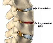 Disco normal da coluna vertebral, disco danificado