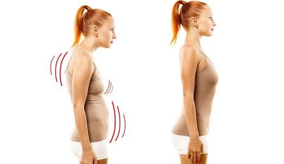 costas retas e má postura com osteocondrose cervical