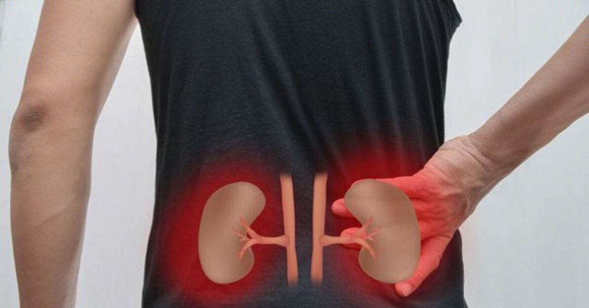 doença renal como causa de dor lombar