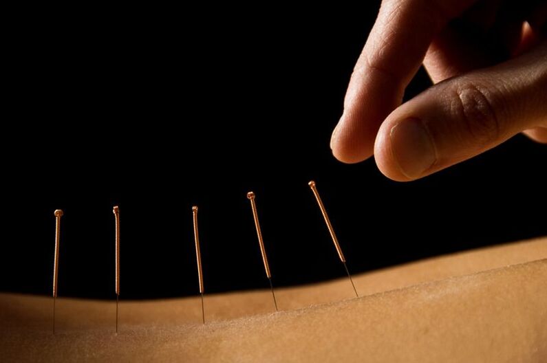 acupuntura para dor lombar