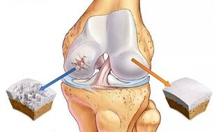 cartilagem saudável e artrose da articulação do joelho